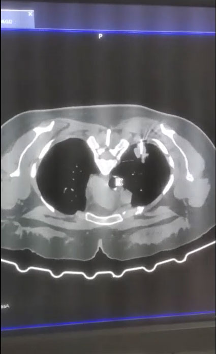 Radiology Biopsy