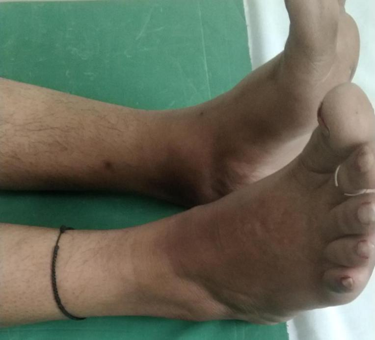 Bilateral Ankle Swelling